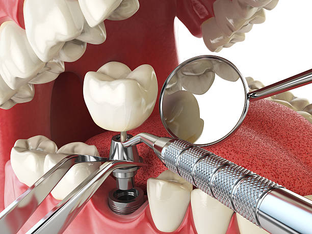 Best Emergency Wisdom Teeth Removal in Green Hill, TN
